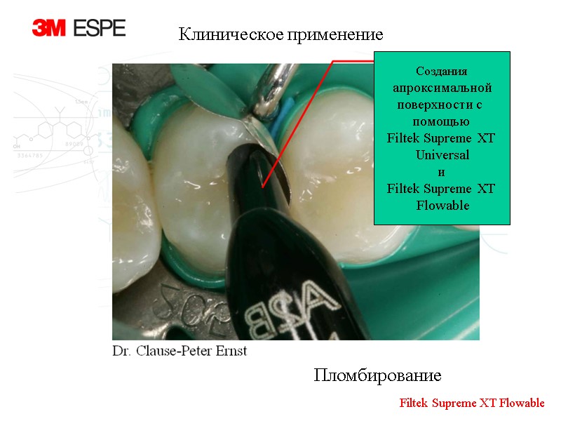 Создания  апроксимальной поверхности с  помощью Filtek Supreme XT  Universal  и